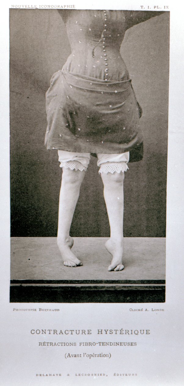 पेरिस, 1889 में प्रकाशित प्रोफेसर जीन मार्टिन चारकॉट (1825-93) की &39;न्यू आईकॉनोग्राफी ऑफ़ सेलपेट्री&39; से अनैच्छिक अनुबंध द्वारा अल्बर्ट लोंडे