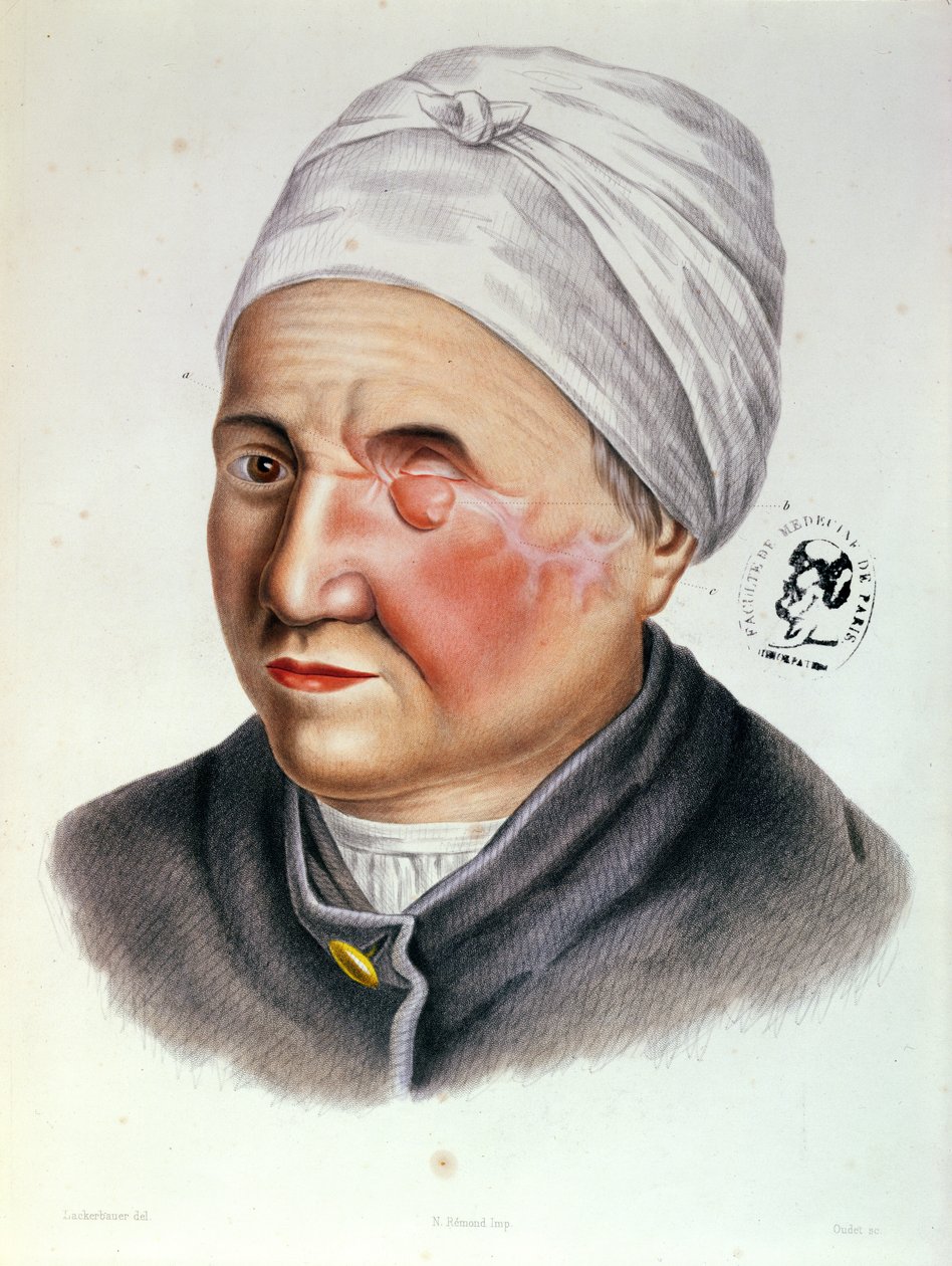 एंटोनी जोबर्ट डी लैम्बल (1799-1867) पेरिस, 1849 द्वारा प्लास्टिक सर्जरी के उपचार से चित्रण द्वारा पेंटर बिल्डर